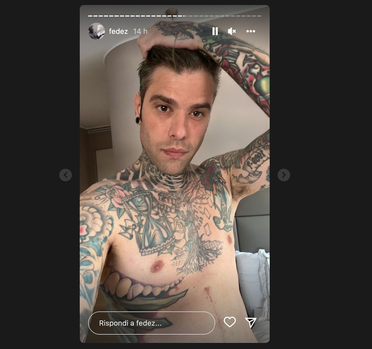 fedez malattia cancro intervento come sta oggi